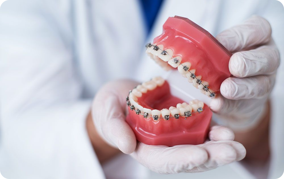 appareils-dentaire-orleans