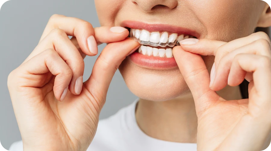 Femme posant une gouttière transparente sur ses dents